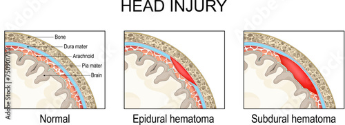 Epidural hematoma and Subdural hematoma. Traumatic brain injury