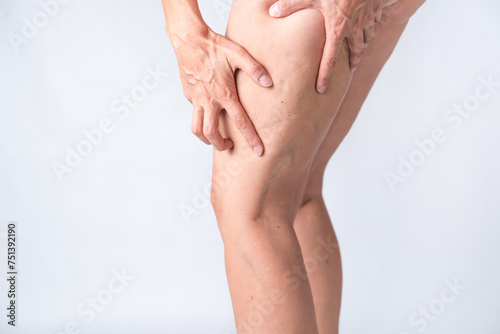 varicose veins and cellulite in women's legs, phlebology