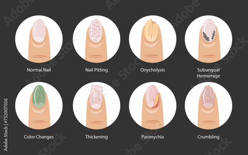 Types of nail pitting disease set collection poster, eight types of nail psoriasis with Healthy, Normal, Pitting, Onycholysis, Subungual, Hematoma, Color Changes, Thickening, Paronychia, Crumbling
