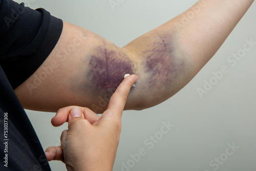Rubbing ointment onto a bruise using a fingertip.