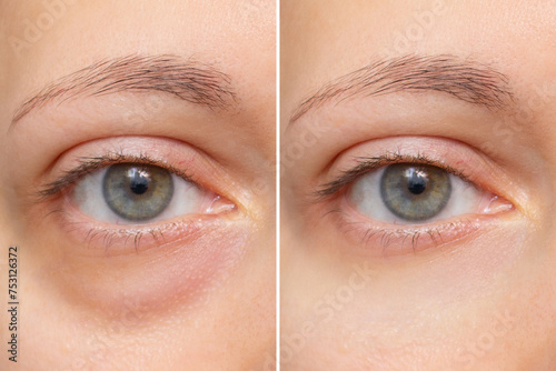 Close-up of the face of a young woman with a bag under her eye before and after treatment. Swelling of the lower eyelid. Removing bruises and dark circles using cosmetics and creams. Blepharoplasty
