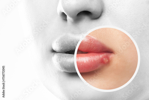 Woman showing herpes disease on her lips. Treatment of viral infections.