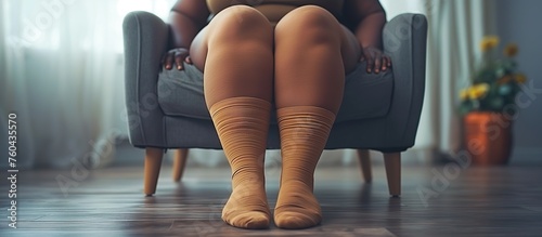 womens legs with lymph edema