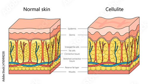 Human cellulite skin structure diagram hand drawn schematic raster illustration. Medical science educational illustration