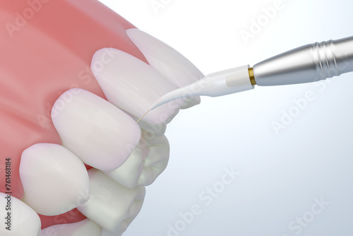 Dental laser with healthy white teeth and pink gums, 3D rendering.