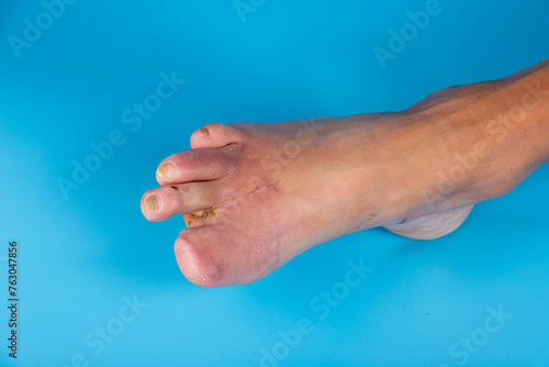 Amputation of diabetic toes of a person on a blue background. Selective focus.