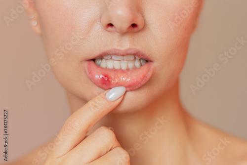 A young woman shows a close-up of a stomatitis ulcer in the acute stage on the mucous membrane of the mouth. Oral problems
