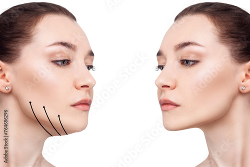 Beautiful woman before and after fat chin correction.
