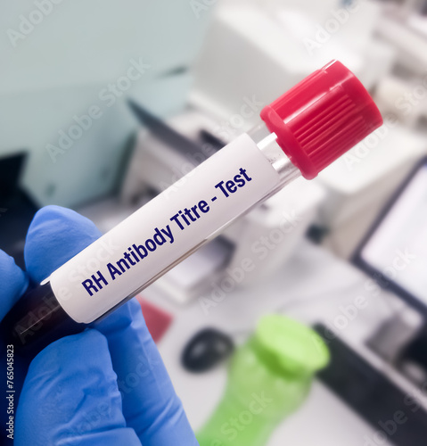 Blood sample for Rh antibody titre. rh incompatibility, Anti-D antibody titre.