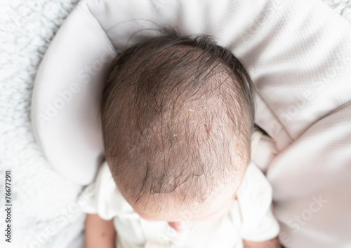 Seborrheic dermatitis crusts on the baby's head. Child with seborrhea in the hair, newborn skin problems