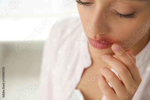 Woman with herpes touching lips against blurred background, closeup