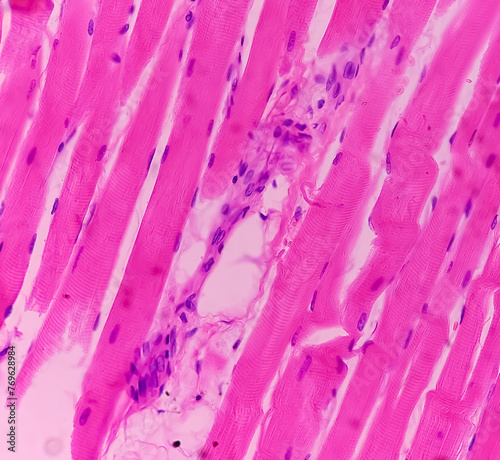 Microscopic image of above knee amputation. Section show fibro collagenous tissue, fatty tissue, skeletal muscles with inflammatory cells. Bony soft tissue resection margin. Bone cancer.