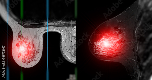 Breast MRI revealing BI-RADS 4 in women indicates suspicious findings warranting further investigation for potential malignancy.