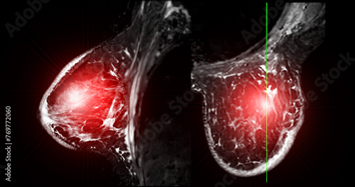 Breast MRI revealing BI-RADS 4 in women indicates suspicious findings warranting further investigation for potential malignancy.