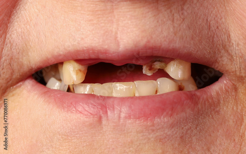 Elderly woman shows toothless mouth, close-up