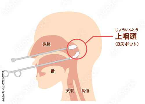 上咽頭擦過治療（Bスポット治療）のやり方と図解