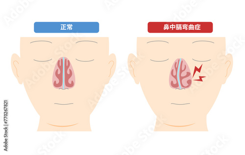 鼻中膈の変形によって起こる鼻中膈弯曲症のイラスト