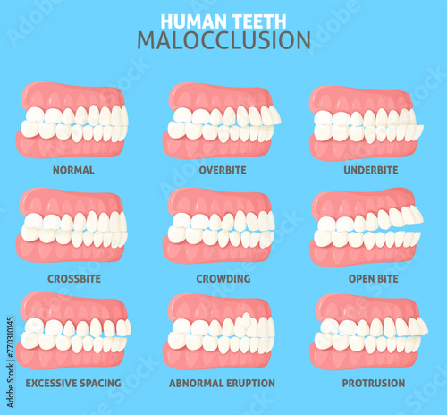 Malocclusion types side view dentist medical poster