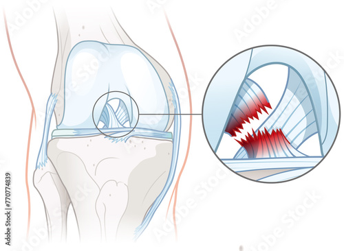 Anterior cruciate ligament tear. Knee injury. Medically illustration