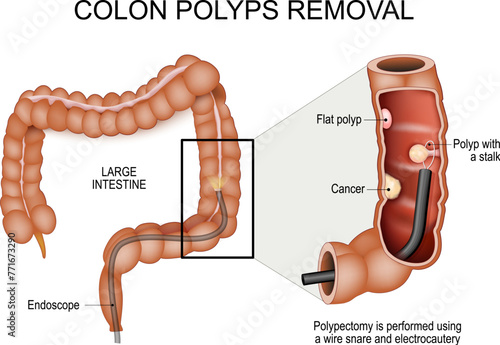 Colon polyps removal. Colonoscopy and Polypectomy.