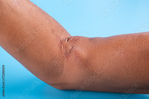 Fistula on the arm as a result of an operation for hemodialysis with kidney failure.