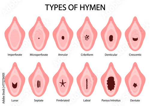 Different Types of Hymen shapes. Parous introitus Microperforate Lunar Septate Fimbriated Labial Crescentic Dentate Cribriform Denticular Aannular Imperforate. Medical procedure vector illustration.