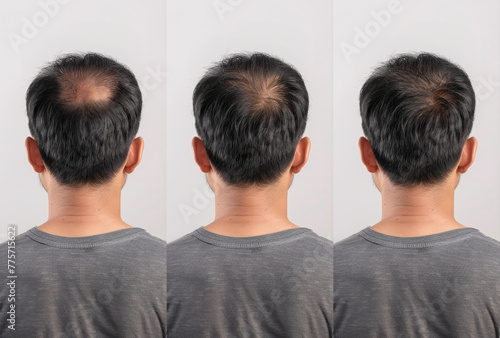 back side of a man with hair loss problem. comparing before and after treatment with thinning or falling hair and noticeably thicker hair and healthier