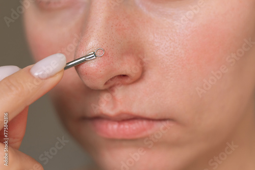 A close-up photo of a young Caucasian woman squeezing out black dots, blackheads on her nose with a special tool. Cleansing the pores of impurities. Cosmetology and dermatology. Acne and pimples