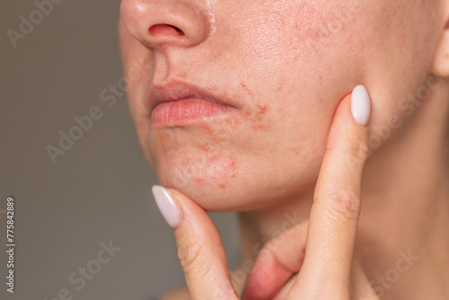 Close-up photo of the face of a young Caucasian woman suffering from perioral dermatitis near the mouth. Skin problems. Dermatology. Skin diseases.