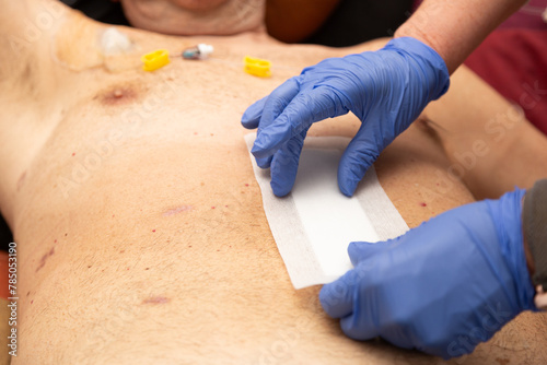 Manos de sanitario poniendo en herida infectada en el abdomen de un hombre portador de un puerto venoso