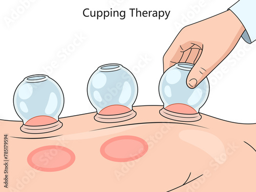 cupping therapy on skin, showcasing suction technique and resulting skin reaction diagram hand drawn schematic raster illustration. Medical science educational illustration