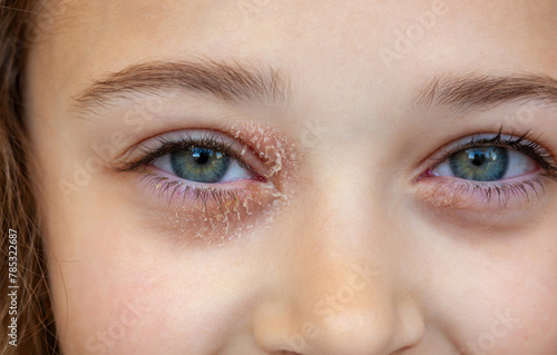 Eye of a little girl suffering from ocular atopic dermatitis or eyelid eczema. Serene and smiling expression.