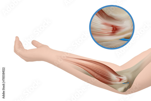 Golfer's Elbow - Medial Epicondylitis_Medical Illustration_Elbow Pain_Elbow anatomy illustration