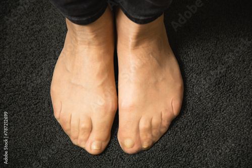 Flat feet and foot toe problems, What Problems Can Flat Feet Cause. High quality photo. 