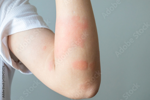Young asian man itching and scratching on arm from allergic itchy dry skin eczema dermatitis insect bites