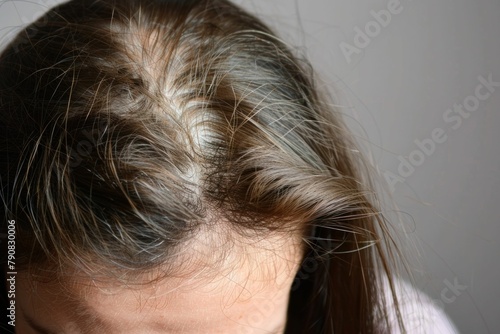Closeup of a woman with hair thinning caused by alopecia areata, showing bald patches and sparse hair growth