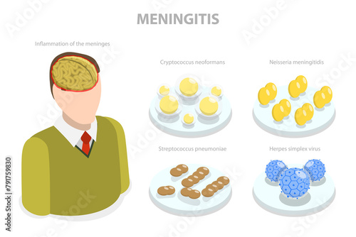 3D Isometric Flat Illustration of Meningitis, Meningococcal Disease, Dangerous Meninges Inflammation