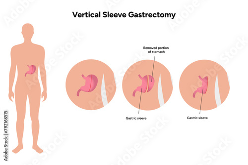Vertical Sleeve Gastrectomy 