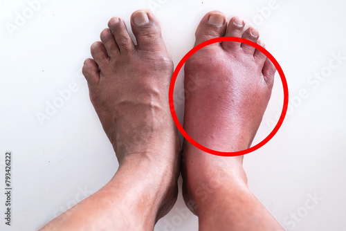 Compare swollen feet from tick bites with normal feet on white background back, enlarged image in red circle frame, skin allergy