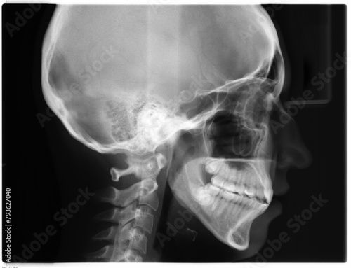 X-ray picture of skull side (Lateral, LAT) view. Human skull, jaw and neck on black background. Woman head.