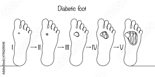 Stages of diabetic foot