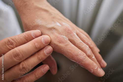 The man's hand, he uses steroids Apply External type.