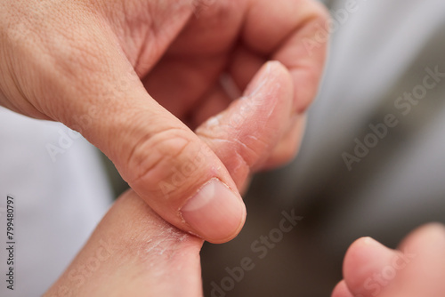 The man's hand, he uses steroids Apply External type.