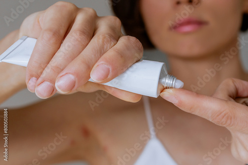 A woman presses the ointment onto her finger and applies it to the bite site by a bedbug on her shoulder on a white background, close-up. Skin health problem. Red pimples.