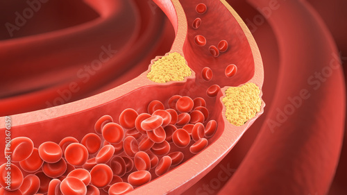 High Blood Cholesterol, Thickened Arteries and Veins, Red Blood Cells, 3d illustration.