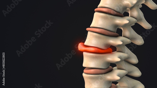 Bulging disc in the human spine