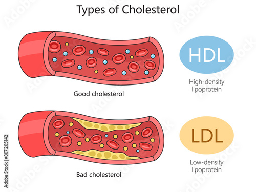 HDL (good) cholesterol and LDL (bad) cholesterol in blood vessels for health education diagram hand drawn schematic raster illustration. Medical science educational illustration