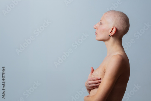 Woman with shaved head hold breast after mastectomy operation