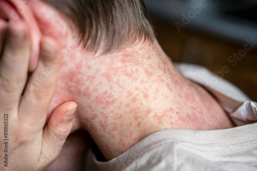 white Teenager covered in measles rash, infectious diseases.