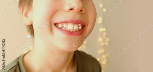 closeup crooked teeth, boy 9-10 years opened mouth, child 8 years old shows teeth, visit to dentist for examination oral cavity, control of molars, temporary teeth, concept of caries prevention